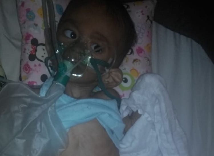 Balia Balqan (3) warga Desa Bidok, Kecamatan Ulim, Kabupaten Pidie Jaya, Aceh, yang mengalami gizi buruk (Foto: liputangampongnews)