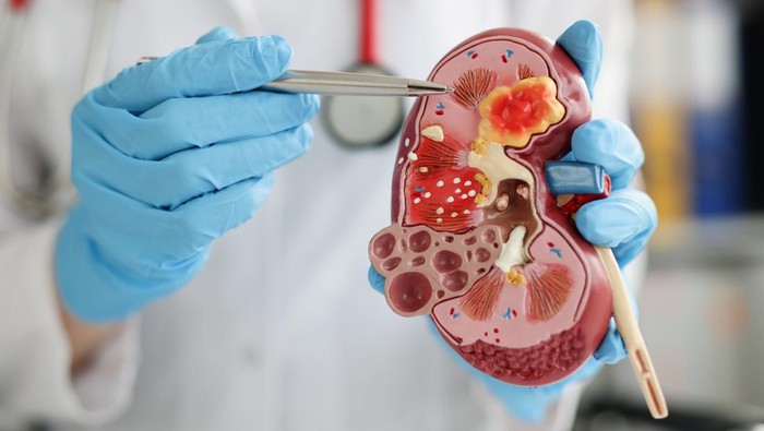 Ilustrasi Kesehatan Ginjal. (Foto: Getty Images/iStockphoto/Ivan-balvan)