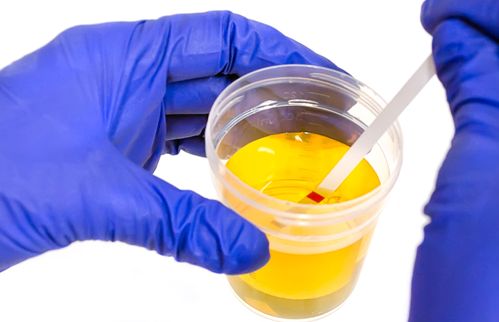 Ilustrasi tes urine. (Foto: Lensamalut)